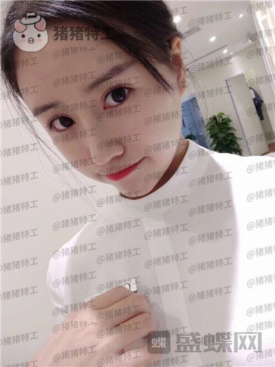 成都格莱丽,王伟,隆鼻,案例,价格,