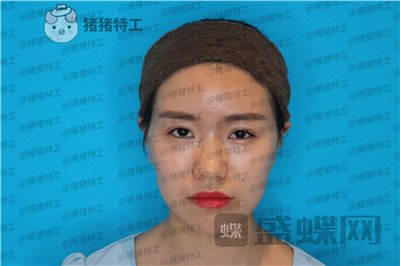成都格莱丽,王伟,隆鼻,案例,价格,