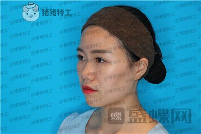 成都格莱丽,王伟,隆鼻,案例,价格,