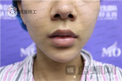 长沙美沃,孔伟立,厚唇改薄,案例,价格,