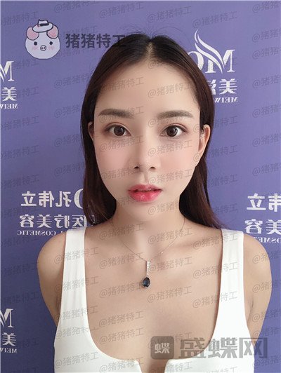 长沙美沃,孔伟立,厚唇改薄,案例,价格,