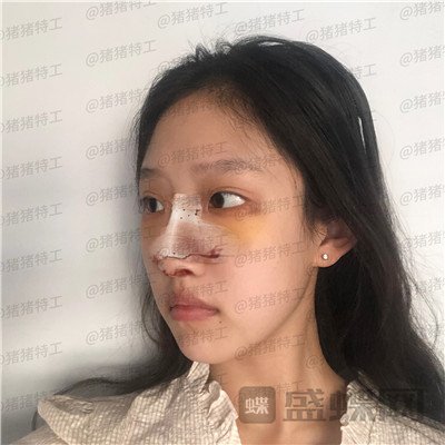 杭州美莱,韩超,,案例,价格,