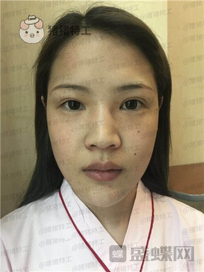 上海伯思立,李茂群,隆鼻,案例,价格,分享,