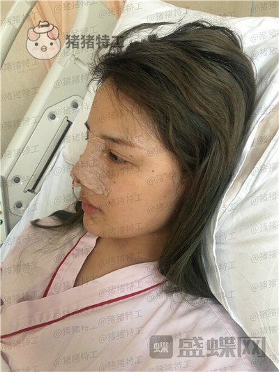 上海伯思立,李茂群,隆鼻,案例,价格,分享,