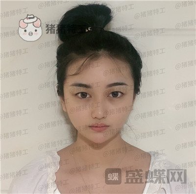 宁波珈禾,费安军,双眼皮,案例,价格,