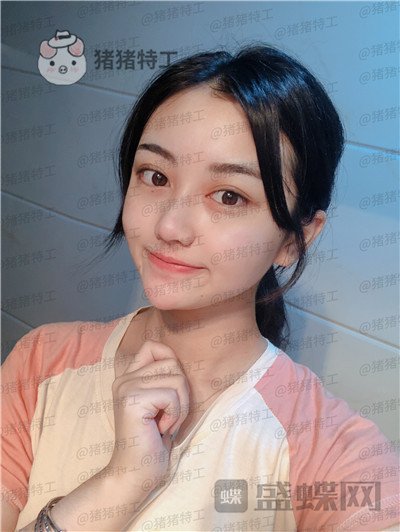 宁波珈禾,费安军,双眼皮,案例,价格,