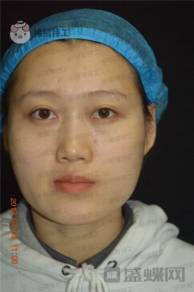 长沙晶肤，朱苗，，案例，价格，