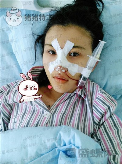 长春艾尔丽赵广文鼻部手术案例价格分享，做了鼻子改变了我的人生~
