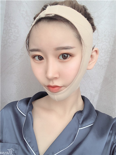 杭州港丽曹飞超面部吸脂怎么样?案例分享