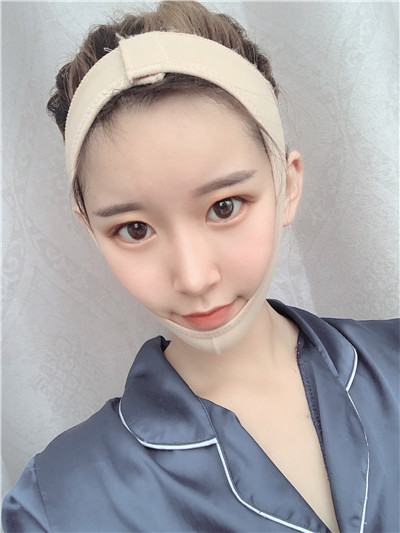 杭州港丽曹飞超面部吸脂怎么样?案例分享