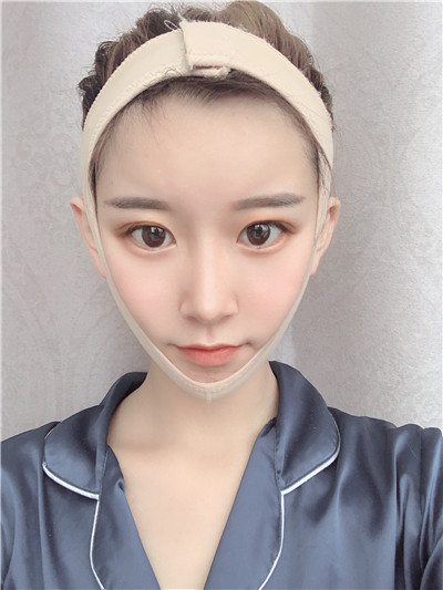 杭州港丽曹飞超面部吸脂怎么样?案例分享