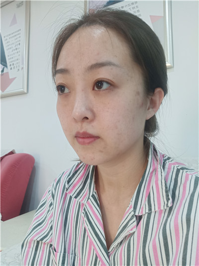 黑龙江瑞丽杨永胜自体脂肪全脸填充怎么样？案例分享