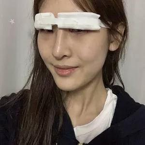 成都美容王立鹏全切双眼皮怎么样?案例分享