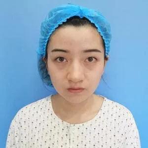 南京美贝尔黄名斗眼鼻部手术怎么样?案例分享