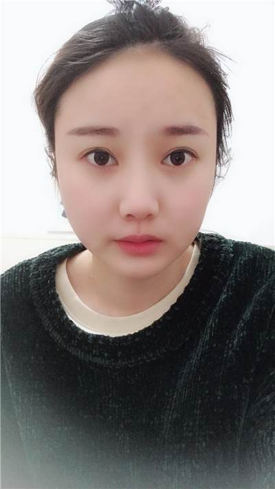 南京柠檬郑翔宇面部吸脂怎么样？案例分享