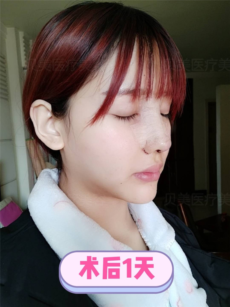 长沙贝美熊宜文隆鼻案例分享，韩式生科硅胶假体隆鼻，鼻修复