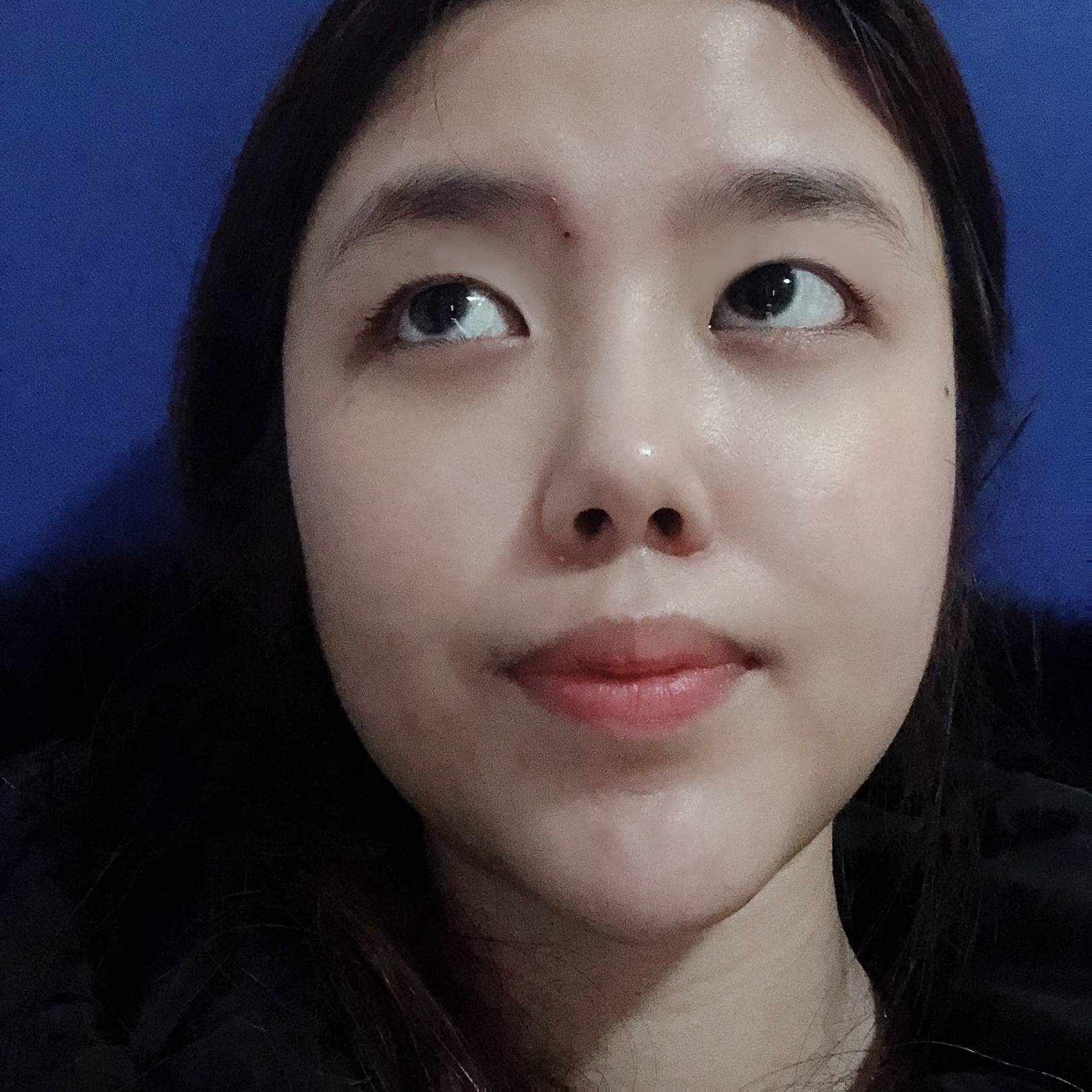 秦皇岛巧致王立英割双眼皮怎么样?案例分享