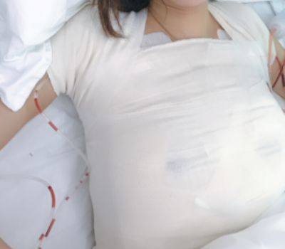 广州荔湾人民医院齐云香隆胸怎么样?价格?口碑?