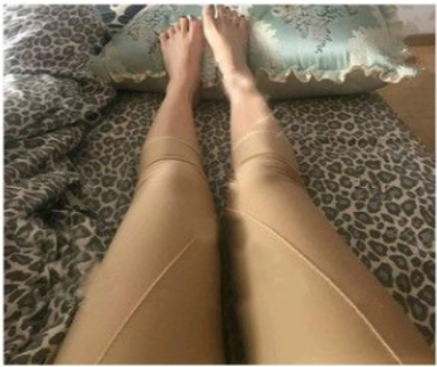 重庆联合丽格王钊吸脂怎么样?价格?口碑?