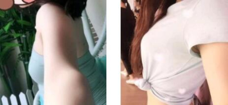 北京东方和谐孙泽芳隆胸怎么样?价格?口碑?