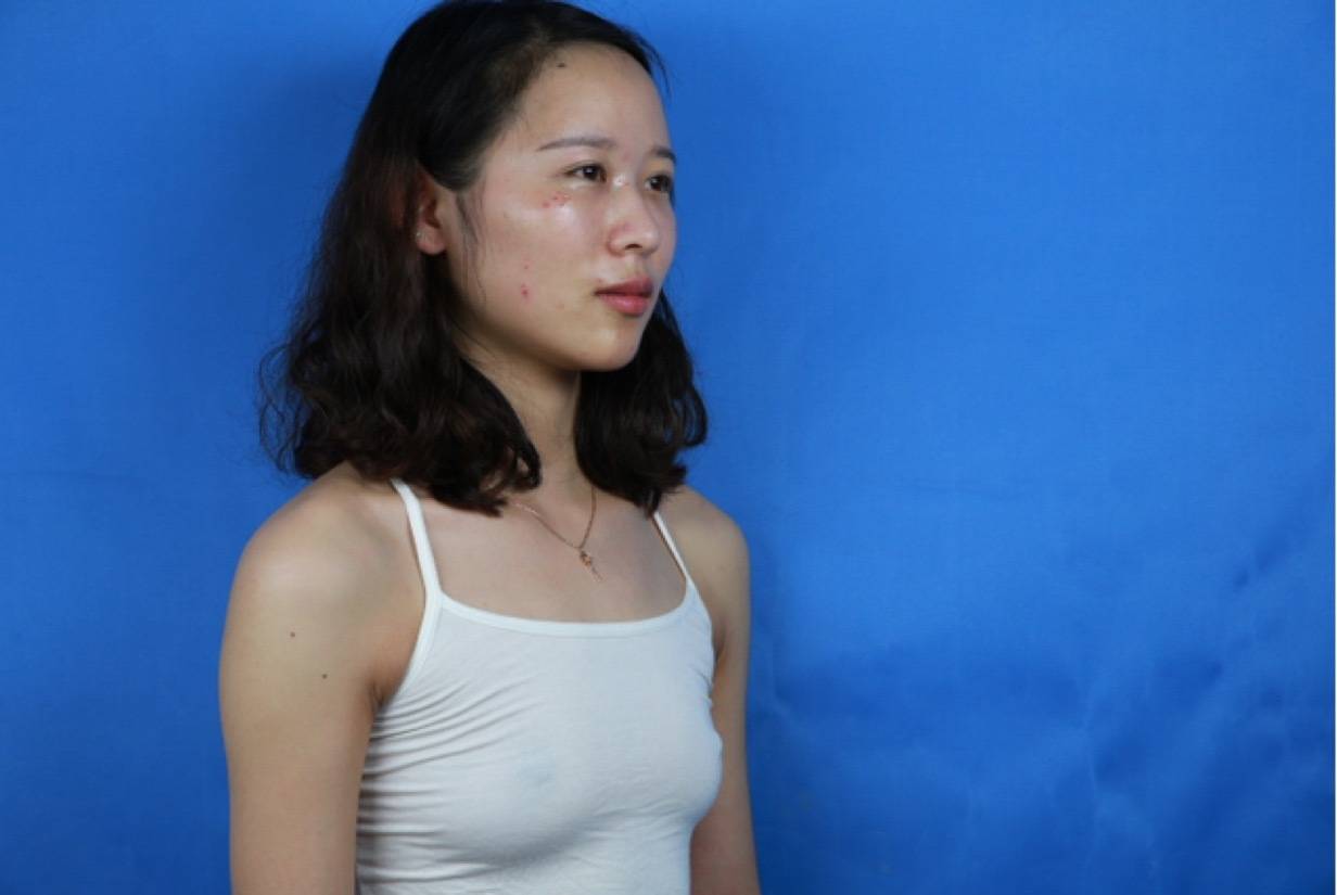 佛山美莱孙婧隆胸怎么样?案例,价格,口碑