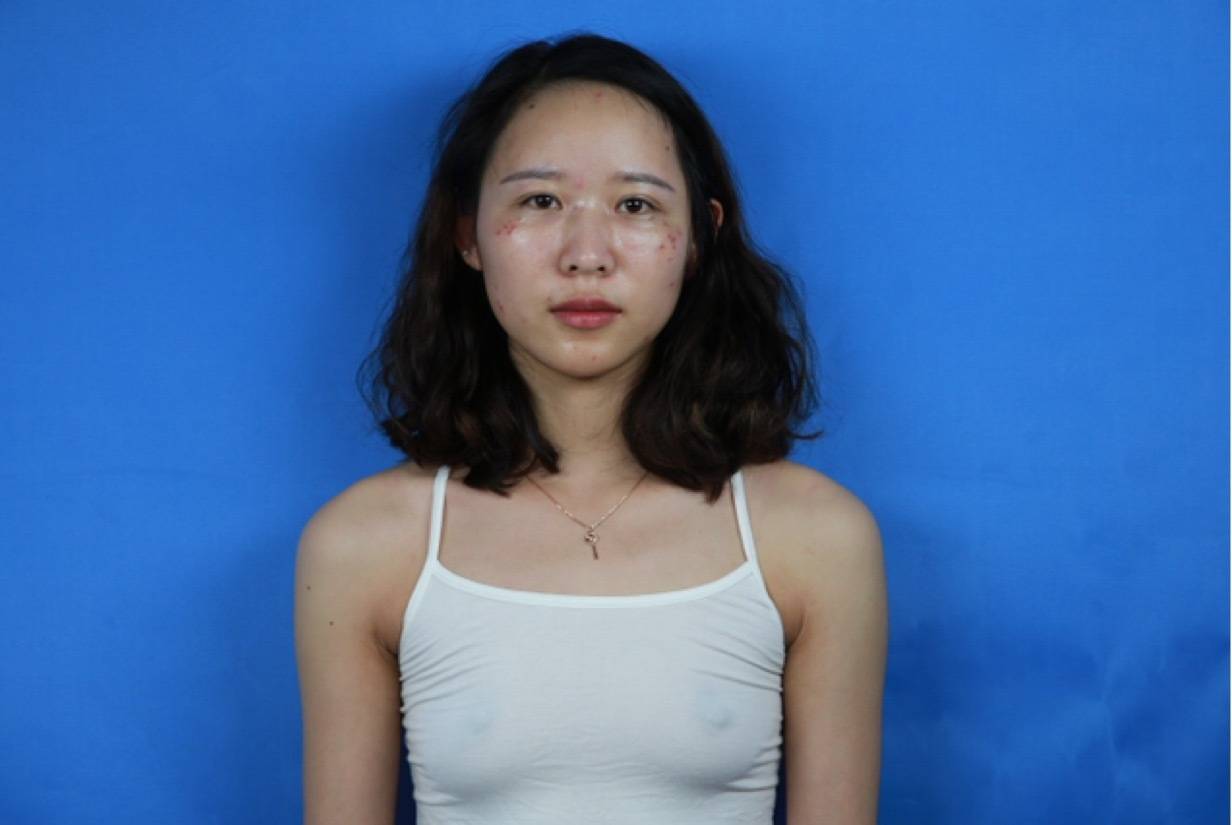 佛山美莱孙婧隆胸怎么样?案例,价格,口碑