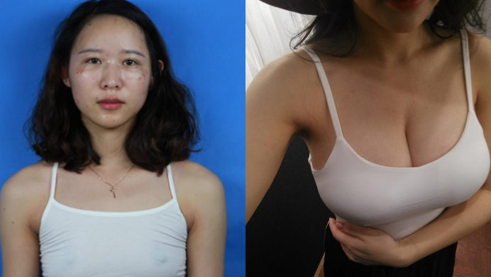 佛山美莱孙婧隆胸怎么样?案例,价格,口碑