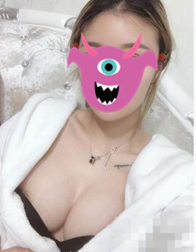 广州壹加壹张红艳隆胸怎么样?案例,价格,口碑