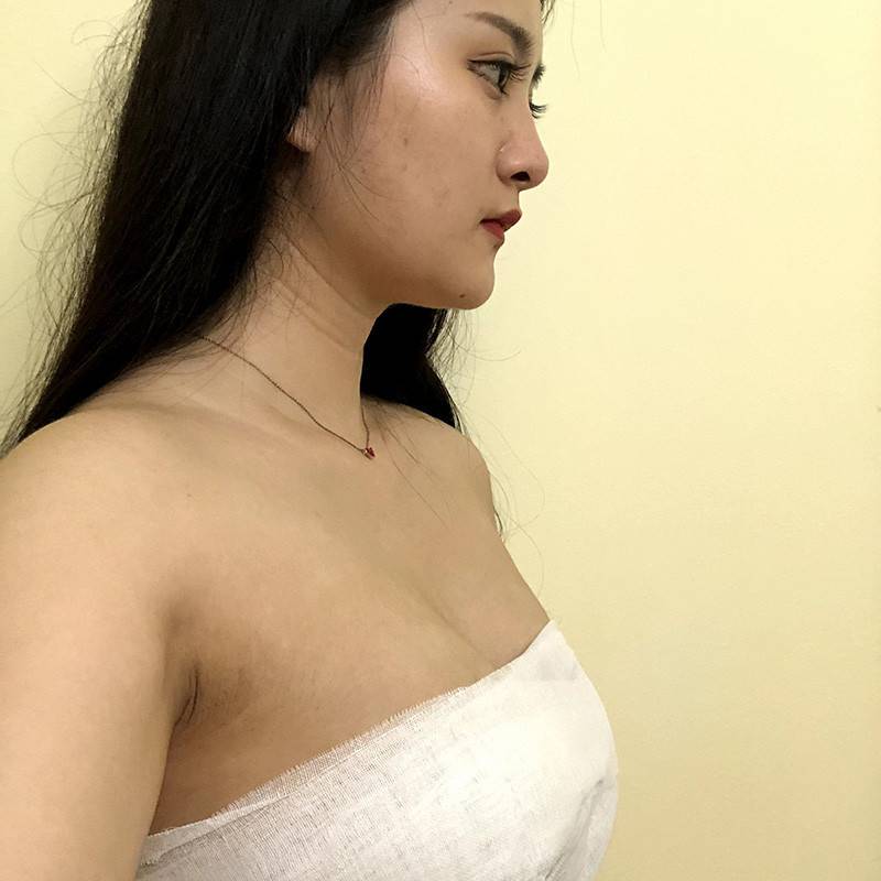 上海东方万伟东隆胸怎么样?案例,价格,口碑
