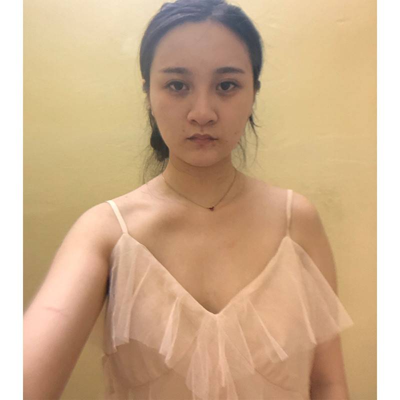 上海东方万伟东隆胸怎么样?案例,价格,口碑