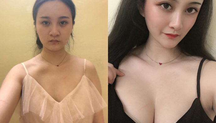 上海东方万伟东隆胸怎么样?案例,价格,口碑