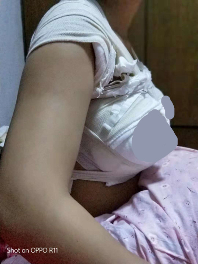 重庆时光高焱隆胸怎么样?案例,价格,口碑