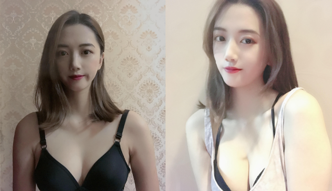哈尔滨雅美吴谦隆胸怎么样?案例,价格,口碑
