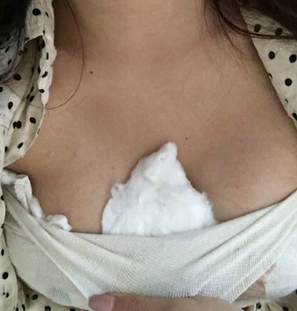 深圳美莱郭杰隆胸怎么样?案例,价格,口碑