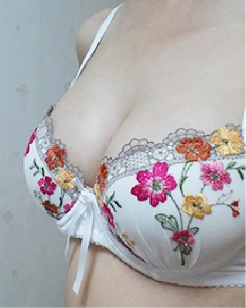 成都娇点姜宇禄隆胸怎么样?案例,价格,口碑