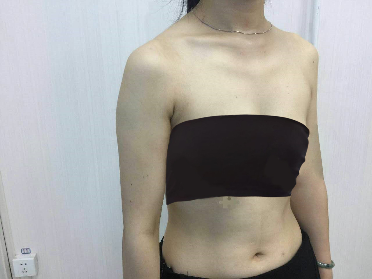 北京韩啸侯泽明隆胸怎么样?案例,价格,口碑