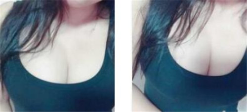 上海联合丽格李鸿君隆胸怎么样?案例,价格,口碑