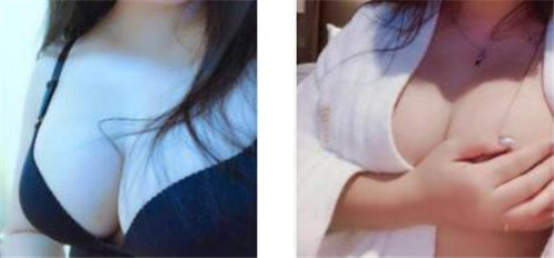 上海联合丽格李鸿君隆胸怎么样?案例,价格,口碑