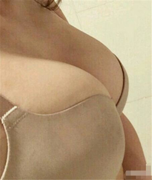 上海美希李攀隆胸怎么样?案例,价格,口碑