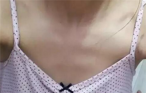 上海玫瑰赵延峰隆胸怎么样?案例,价格,口碑