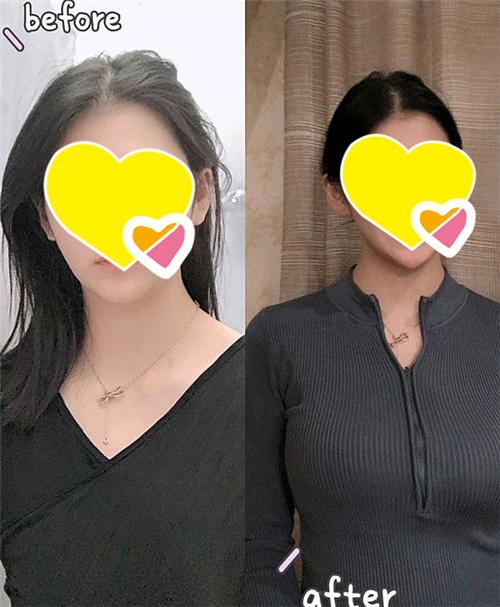 上海艺星唐毅隆胸怎么样?案例,价格,口碑