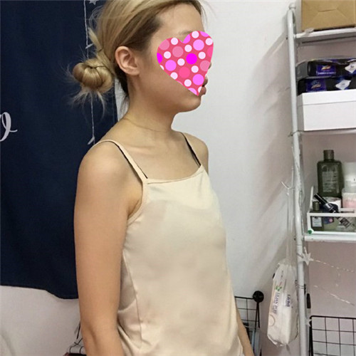 北京艺美王东隆胸怎么样?案例,价格,口碑