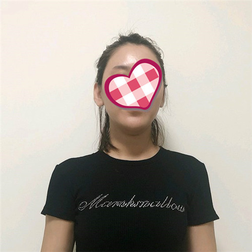 上海伊莱美邱文苑隆胸怎么样?案例,价格,口碑