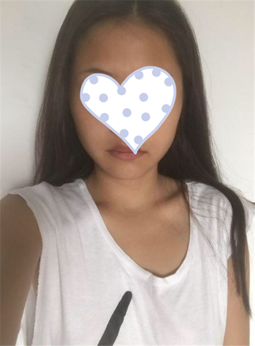 上海玫瑰张东旭隆胸怎么样?案例,价格,口碑