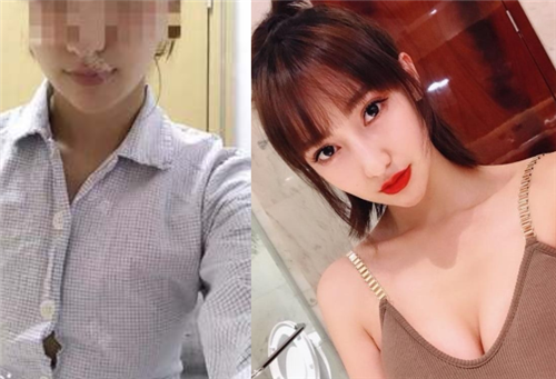 北京美莱曾昂隆胸怎么样?案例,价格,口碑