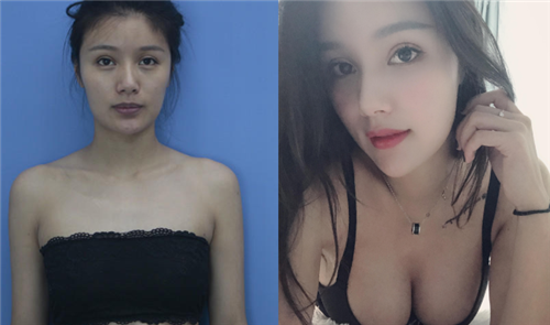 上海艺星彭才学隆胸怎么样?案例,价格,口碑
