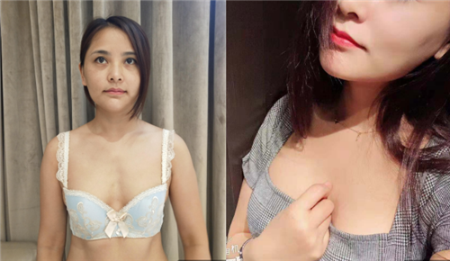 上海时光许黎平隆胸怎么样?案例,价格,口碑