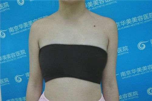 南京华美沈正宇隆胸怎么样?案例,价格,口碑