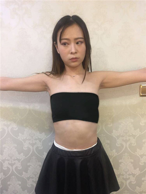 南京华美沈正宇隆胸怎么样?案例,价格,口碑