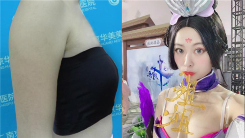 南京华美沈正宇隆胸怎么样?案例,价格,口碑